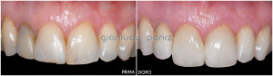 Esthetic rehabilitation with porcelian laminate veneers and crowns