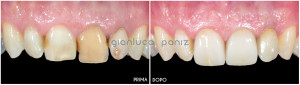 Esthetic rehabilitation with porcelian laminate veneers and crowns 2