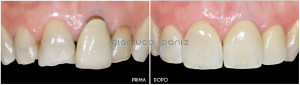 Esthetic rehabilitation with porcelian laminate veneers and crowns 3