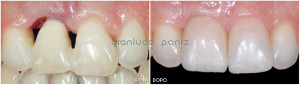 ANTERIOR IMPLANT-SUPPORTED RESTORATION and PORCELAIN LAMINATE VENEER 1