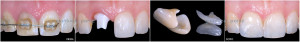 ANTERIOR IMPLANT-SUPPORTED RESTORATION and PORCELAIN LAMINATE VENEER 2