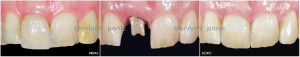 ANTERIOR IMPLANT-SUPPORTED RESTORATION