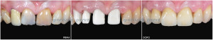 ANTERIOR REHABILITATION WITH TEETH AND IMPLANTS 1