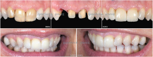 ANTERIOR REHABILITATION WITH TEETH AND IMPLANTS 1