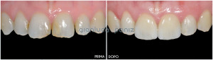 PORCELAIN LAMINATE VENEERS