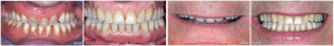 REMOVABLE COMPLE DENTURE AND FIXED COMPLETE DENTURE IMPLANT-SUPPORTED.