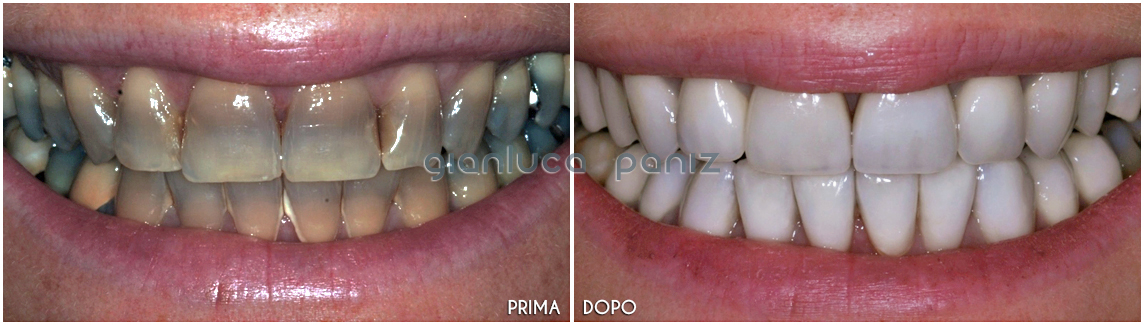 clinical evaluation of 546 tetracycline-stained teeth treated with porcelain laminate veneers