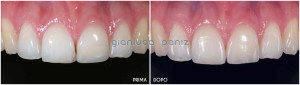 ESTHETIC RESTORATION WITH COMPOSITE RESIN