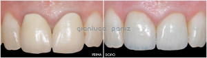 CERAMO-METAL CROWNS SUBSTITUTION into ALL-CERAMIC CROWNS