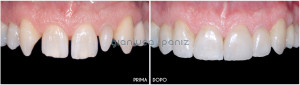 PORCELAIN LAMINATE VENEERS