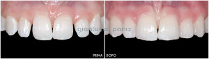 PROSTHETIC FINALIZATION of ORTHODONTIC TREATMENT